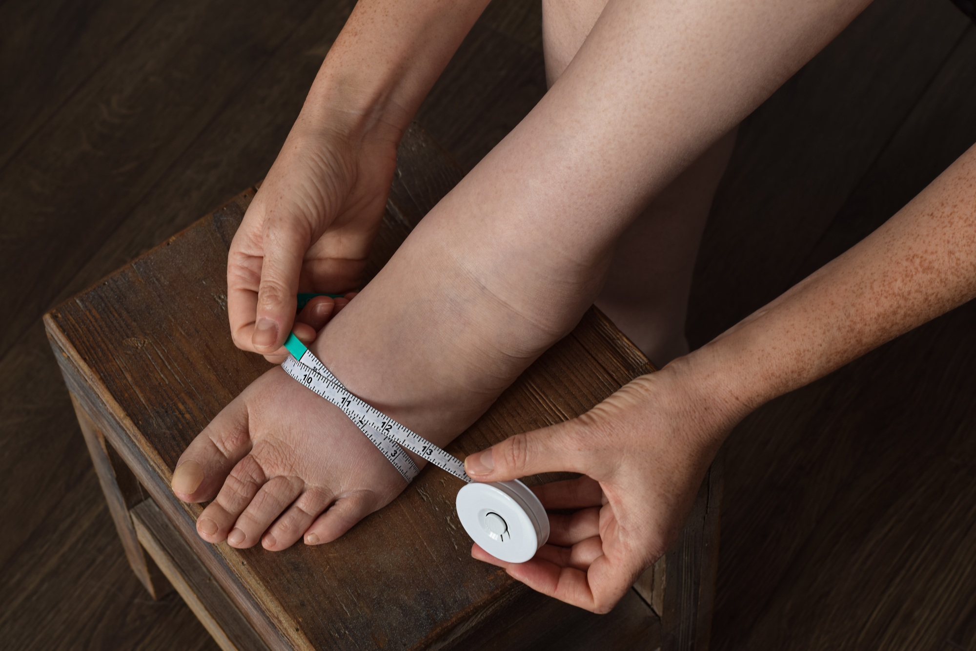Messung der Füße zur Kompressionstherapie